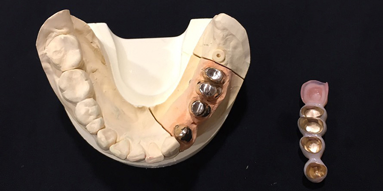 コーヌステレスコープ義歯 | 東京の入れ歯専門サイト