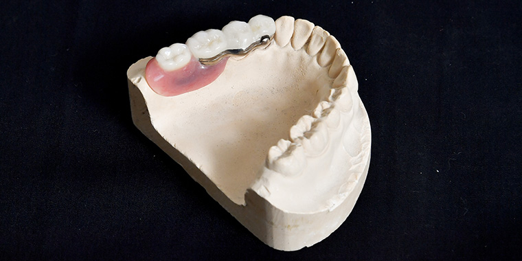 ドイツ式入れ歯 テレスコープ義歯 | 東京の入れ歯専門サイト